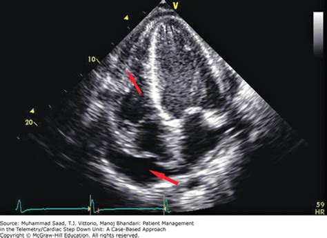 Abnormal Echocardiogram Results