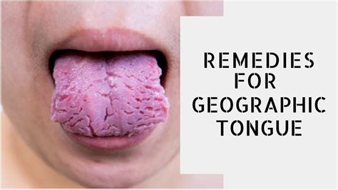 Geographic Tongue Geographic Tongue Treatment Geographic Tongue