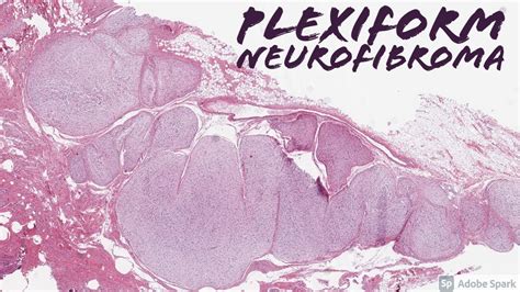 Plexiform Neurofibroma In Neurofibromatosis 1 Nf1 5 Minute Pathology