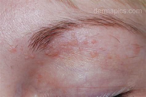 Flat Warts Pictures And Clinical Information From The Dermatology