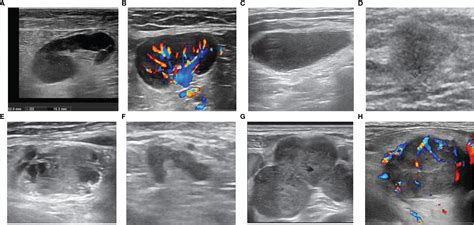 Swollen Lymph Nodes Armpit Ultrasound