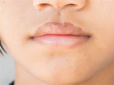Lip Eczema Cause Symptoms On Baby How To Treat Cure Home Remedies