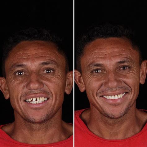34 Antes E Depois De Pessoas Que Tiveram Seus Dentes Consertados Por