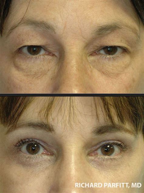 Blepharoplasty Eyelid Surgery Wi Patient 22 Eyelid Surgery Eye Lift
