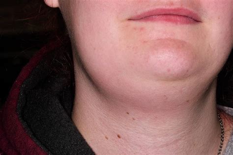 Swollen Glands Photograph By Dr P Marazziscience Photo Library Images