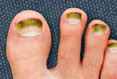 ≡ 11 Serious Health Warnings That Appear On Toenails 》 Life 360 Tips