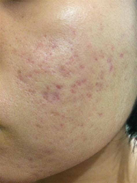 Advice On What To Do With These Acne Scars Scar Treatments Forum