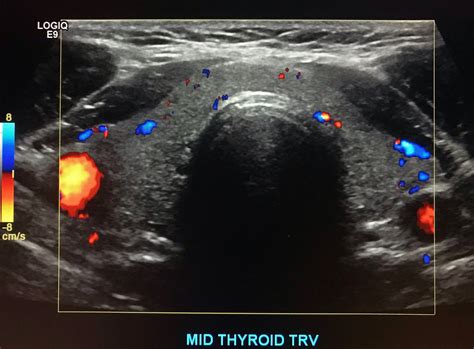 Thyroid Ultrasound Protocol Sonographic Tendencies