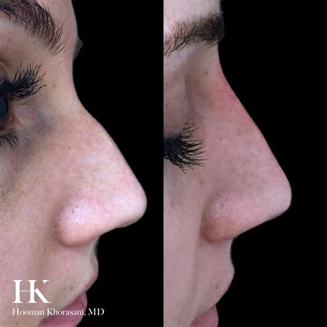 Nose Reshaping Cosmetic Surgeon Nyc