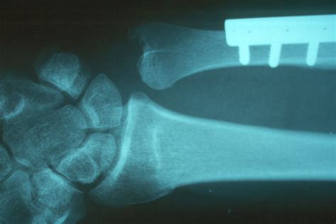 Reconstruction Ulnar Shortening Osteotomy For Distal Radius Fracture