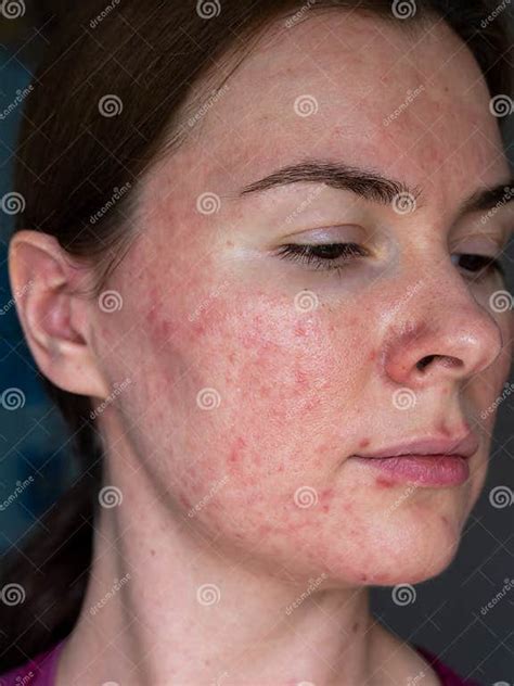 The Skin Of A Patient With Papulopustular Rosacea Stock Image Image