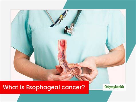Esophageal Cancer Types Stages Symptoms Causes Diagnosis And