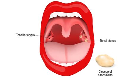 What Are Tonsil Stones Causes Symptoms And Treatments Live Science