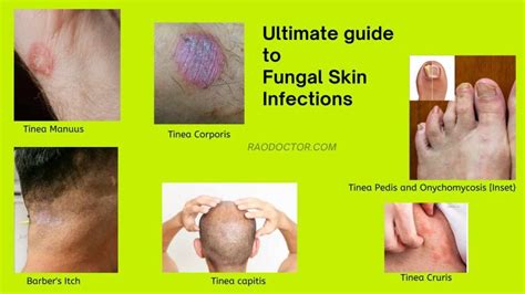 Ultimate Guide To Fungal Skin Infections How To Tackle Them Patientparadise