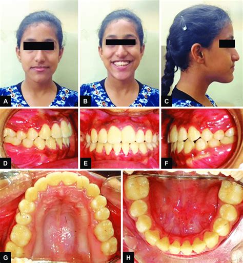 A To H Posttreatment Images A Extraoral Front View B Extraoral