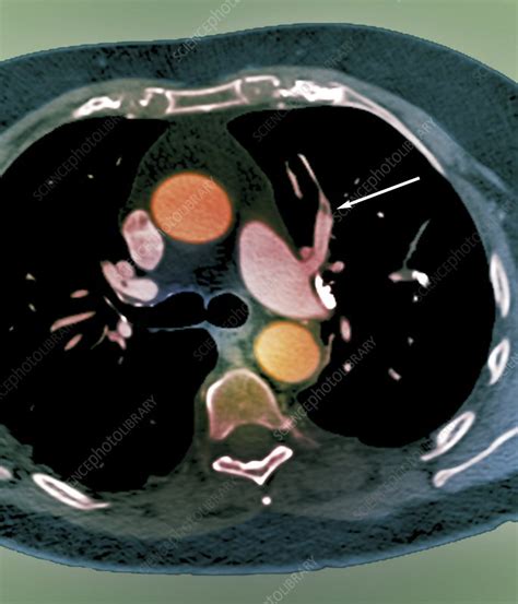 Pulmonary Embolism Ct Scan Stock Image C0104916 Science Photo