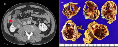 Preoperative Contract Ct Scans Of Cystic Renal Tumor And Gross Picture