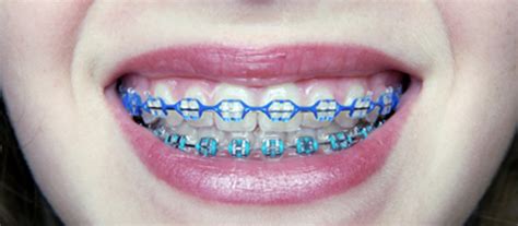 The Most Common Types Of Braces Canyon Vista Dental