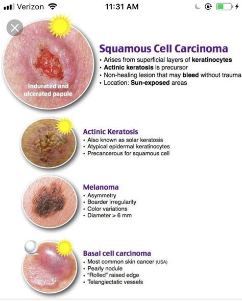Pin By Ig On Skin Lesions Cancer Nurses Squamous Cell Carcinoma