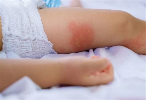 Atopic Eczema Baby Eczema Causes Symptoms And Treatment