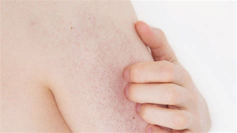 7 Reasons Your Skin Has Red Spots And Bumps Keratosis Pilaris Skin