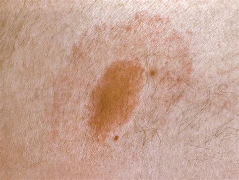 Lyme Disease May Be Associated With Genital Lesions And Morgellons