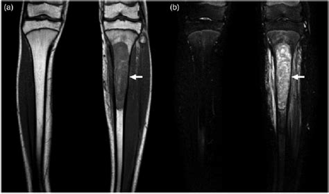 A 15 Year Old Boy With Ewing Sarcoma Of The Left Tibia Coronal T1w A