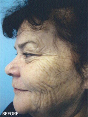 Skin Rejuvenation Patient 07 Temecula Ca Dr Kelly Oneil