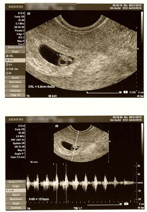 6 Week Ultrasound Heartbeat