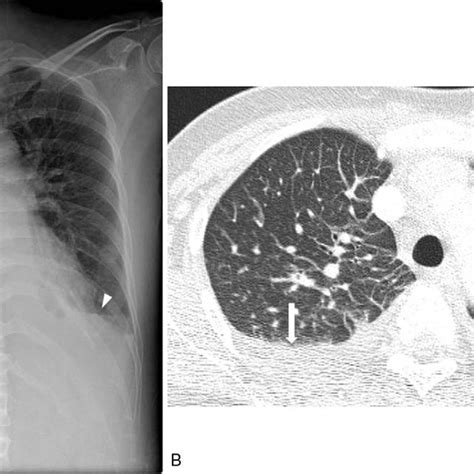 Chest Radiography And Ct Of A Patient With Scrub Typhus A Chest