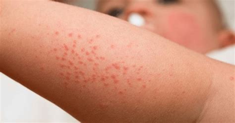 Dermatite At Pica Em Crian As Conhe A As Causas Sintomas E Tratamentos