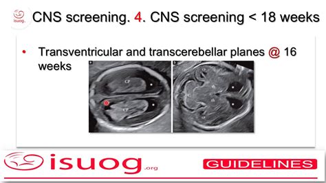 Isuog Guidelines On The Sonographic Examination Of The Fetal Cns Part