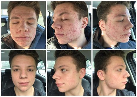 Before and after 4 months of accutane 🙂🙂 : Accutane