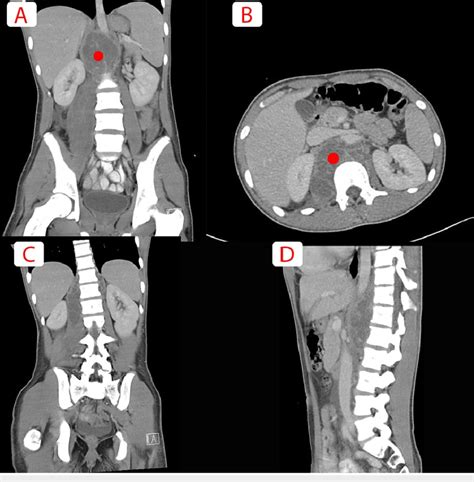 A Axial And B Sagittal View Of A Ct Scan Of Abdomen An Pelvis