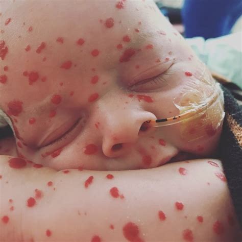 Baby Covered In Red Birthmarks After Surviving A Stroke When He Was