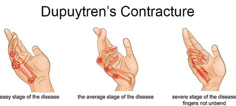 Dupuytrens Contracture Form Hand Wrist And Elbow Institute