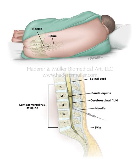Lumbar Puncture Haderer And Muller