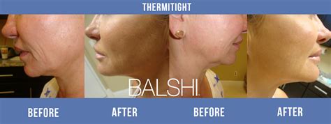 Thermitight Before After Balshi Dermatology Delray Beach South