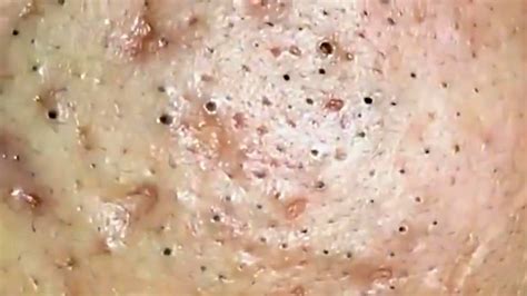 Best Pimple Popping Video 5 Youtube