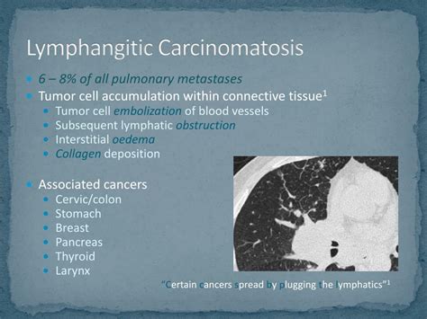 Ppt Lymphangitic Carcinomatosis Powerpoint Presentation Free