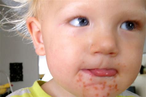 Rashes caused by an antibiotic allergy may last 3 to 14 days, whereas diaper rash almost always allergic reactions — avoid the specific food, medicine. 10 Common Skin Rashes in Children | Hergamut.com