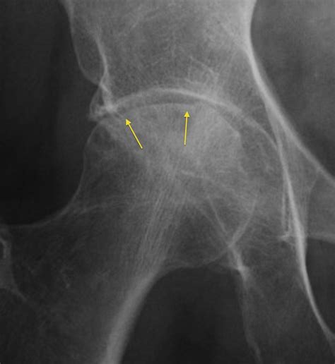 The Lesions In The Right Femoral Head Subchondral Bone Necrosis My