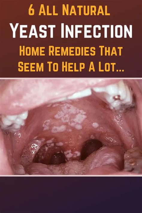 6 Natural Yeast Infection Home Remedies Worth Trying