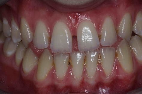 Mothlhtqqjbpqdp Front Tooth Filling Before And After