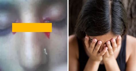 Woman Bleeds From Her Eyes When She Has Period Due To Incredibly Rare Case Small Joys