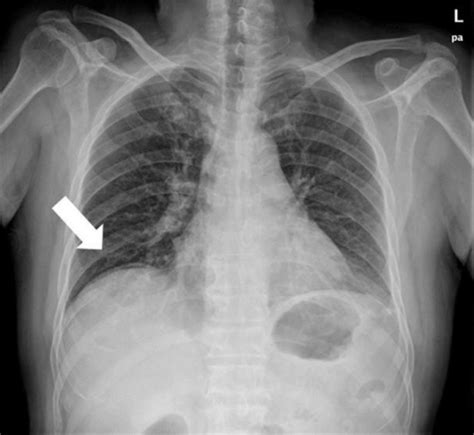 Chest Radiograph Shows Free Air In The Subphrenic Space Open I