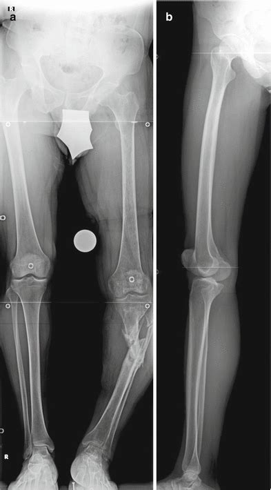 Femoral And Tibial Deformity Correction And Consecutive Lengthening My Xxx Hot Girl