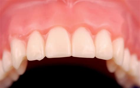 Bumps on gums mainly appear as hard little lumps with pain or no pain. Five Ways to Prevent Gum Disease