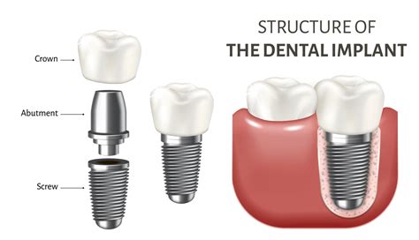 Dental Implants Frequently Asked Questions Arizona Periodontal Group