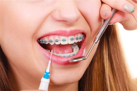 Importance Of Regular Braces Appointment Mcdonald Orthodontic